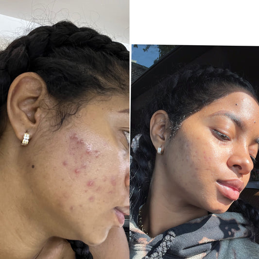 Jabón para las manchas y las espinillas. Envío incluido